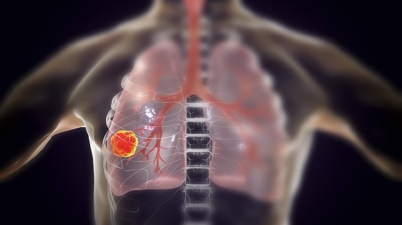 Lung tumor in human patients. Graphical representation. 