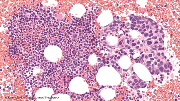 Bone marrow biopsy