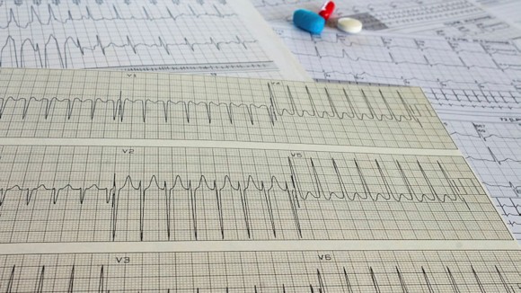 Electrocardiogram with cardiac arrhythmia. Medications for arrhythmia treatments.