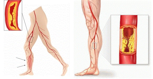 Symptomatisch perifeer arterieel vaatlijden en stepped care