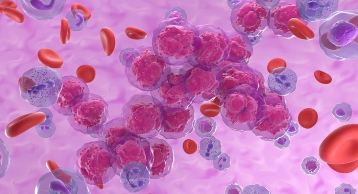 Illustration of acute lymphoblastic leukemia (ALL) cancer cell clusters in the blood flow. ALL is a type of blood cancer originating in the bone marrow, the spongy tissue inside bones where blood cells are made.