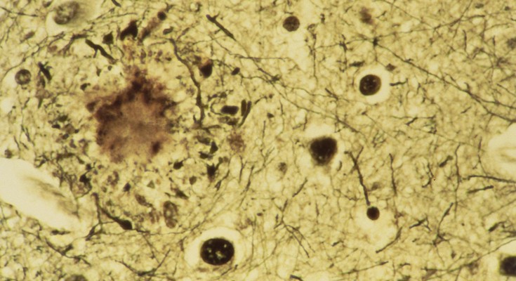A circular brown splotch on a yellow background with smaller brown dots - a protein plaque on the brain