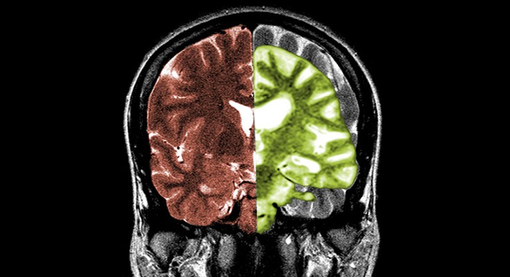 Split image showing MRI scans of a normal brain on left and an Alzheimer's brain on right