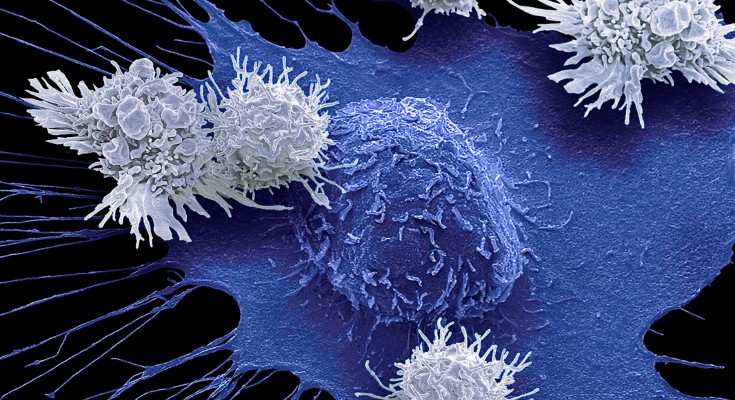 Composite conceptual coloured scanning electron micrograph of T cells and a breast cancer cell