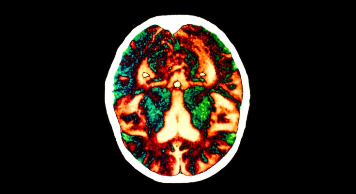 A coloured computed-tomography scan of a brain affected by Alzheimer's disease
