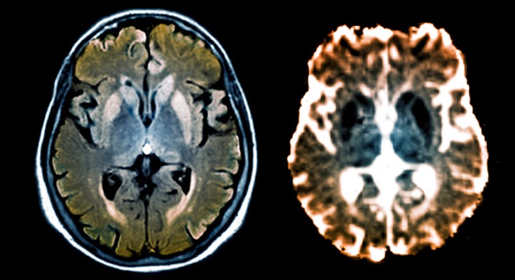 Composite image of FLAIR and diffusion MRI scans of the brain of a 47-old patient