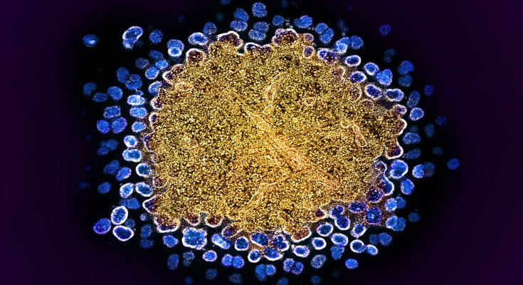 An image of an immune cell covered in yellow, with blue-coloured HIV particles around its edges, on a black background