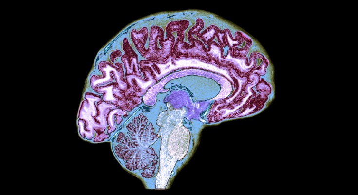 A coloured scan photo of the brain
