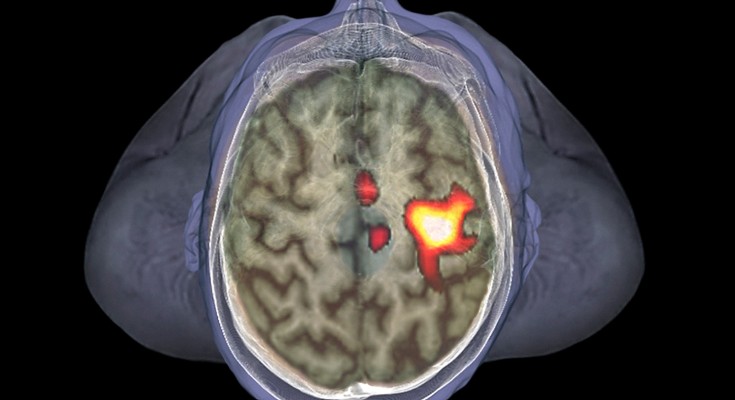 A scan of the brain with areas highlighted in red