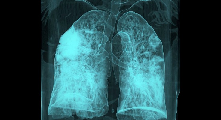 A blue scan image of lungs. The image is cloudy