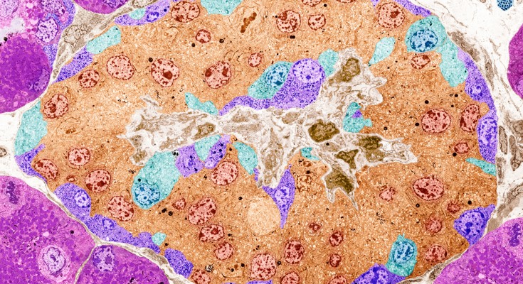 Coloured transmission electron micrograph of Islets of Langerhans from a human pancreas shown in pink, purple, cyan and orange colours