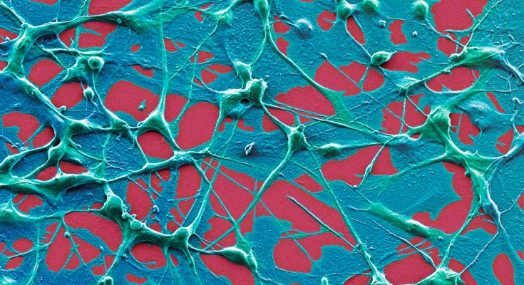 Stringy blue skin cancer cells are spread across a red background