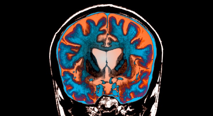 FLAIR magnetic resonance imaging (MRI) scan of a coronal section through the brain of a 21-old patient with Huntington's disease.