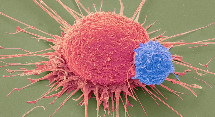 An electron micrograph image of a prostate cancer cell in pink being attacked by a T cell in blue