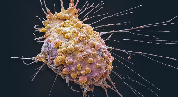 An illustration of a tumour cell