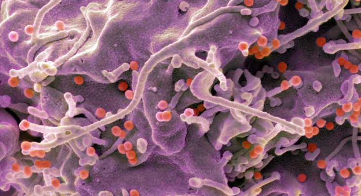 Coloured scanning electron micrograph of a 293T cell infected with HIV (red dots)