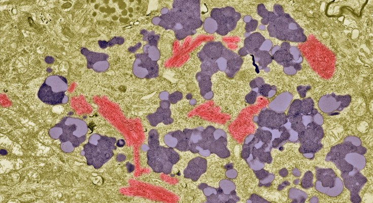 Coloured transmission electron micrograph of a neuron in Alzheimer's disease