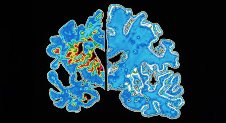 Computer graphic of a blue vertical slice through the brain of an Alzheimer's patient on the left and a normal brain on the right on a black background