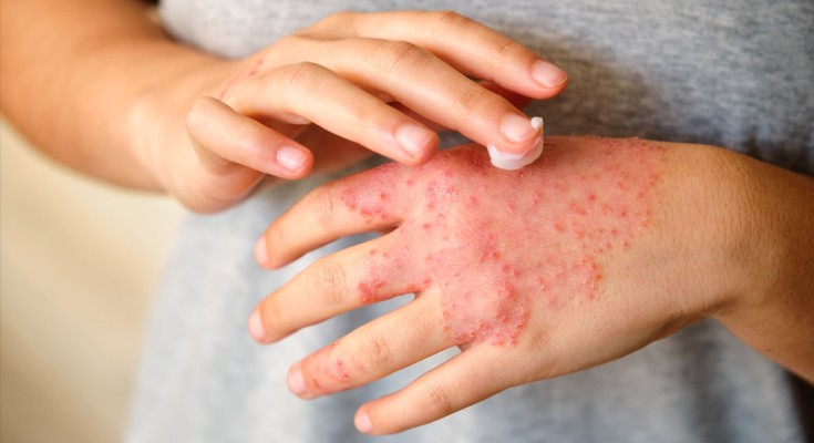 Close up view of a woman's hands as they applies a moisturizing cream to the eczema affecting the back of her left hand
