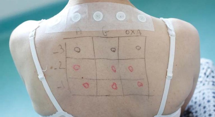 A woman sits with her back to the camera. A physician has drawn a grid on her back with circles on it, where her sensitivity to certain allergens is being tested.