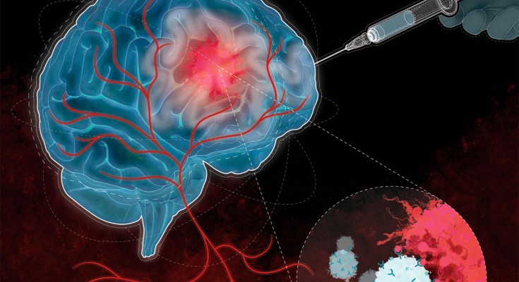 An illustration of local injection of chimeric antigen receptor (CAR) T cells (white) for glioblastoma. 