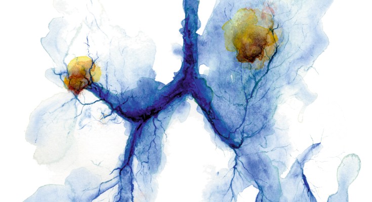 The abstract watercolor image on the cover shows a pair of lungs with two tumors, highlighting their spread through air spaces and the effects of cachexia on the diaphragm and adipose tissues.