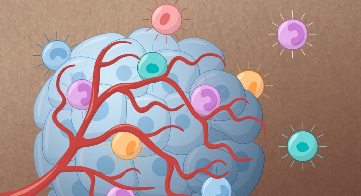 tumour with lymphocytes infiltrating