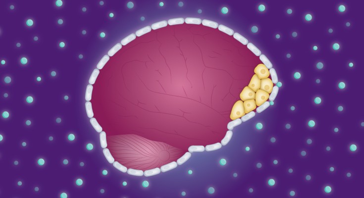 a brain tumour with drugs entering in
