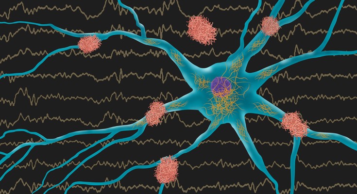 A neuron with amyloid and tau pathology on a background showing epileptiform EEG activity