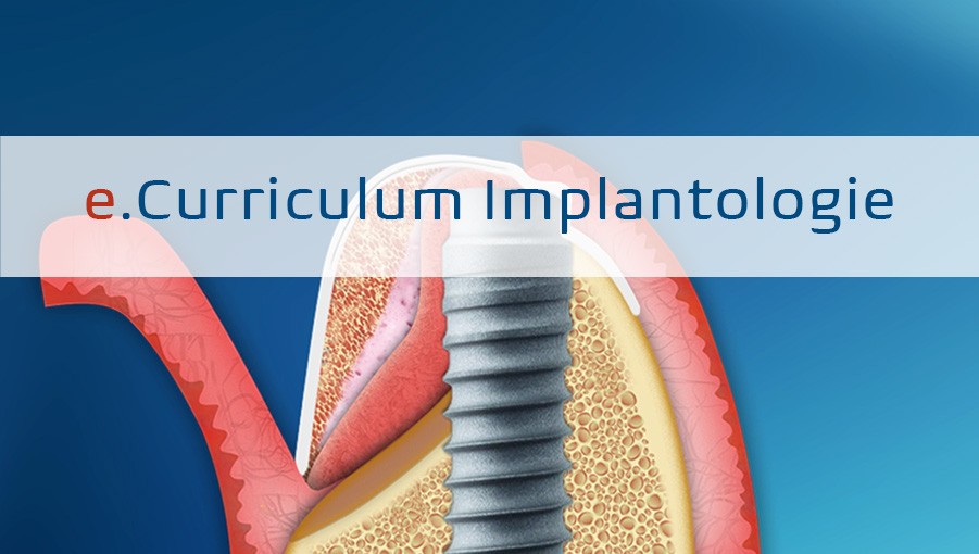 Cover für Online-Artikel 5.2 Knochenregeneration zur Alveolarkammaugmentation