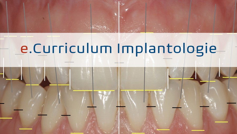 Cover für Online-Artikel 9.2 Prothetische Analyse und Planung sowie ihre Bedeutung bei Okklusion und Belastung